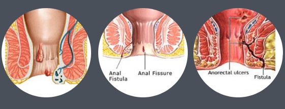 Laser Surgery for Piles, Fissure, and Fistula in Surat | A Complete Guide by Dr. Anup Patki