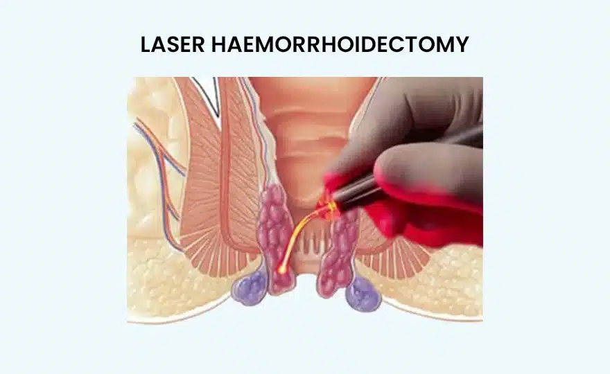 Best Piles Laser Treatment in Surat | Complete Guide