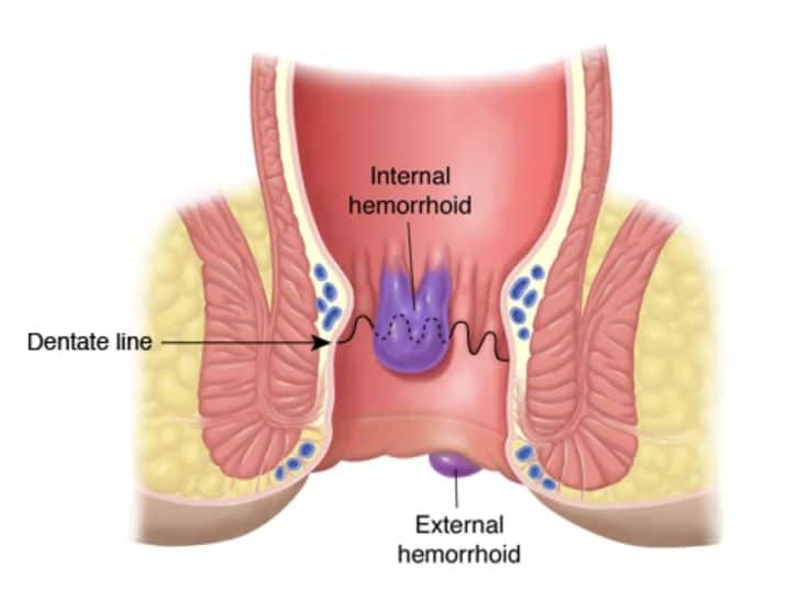 Best Piles Treatment Doctors Near Adajan,Surat