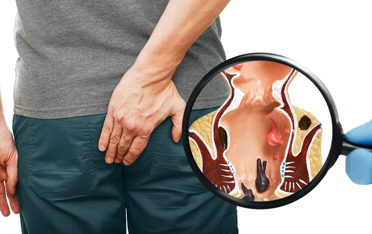 Best Piles Doctor in Rander | Dr.Anup Patki