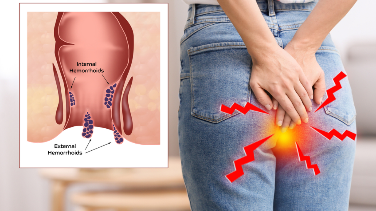 Best Piles Doctor in Bharuch | Dr.Anup Patki