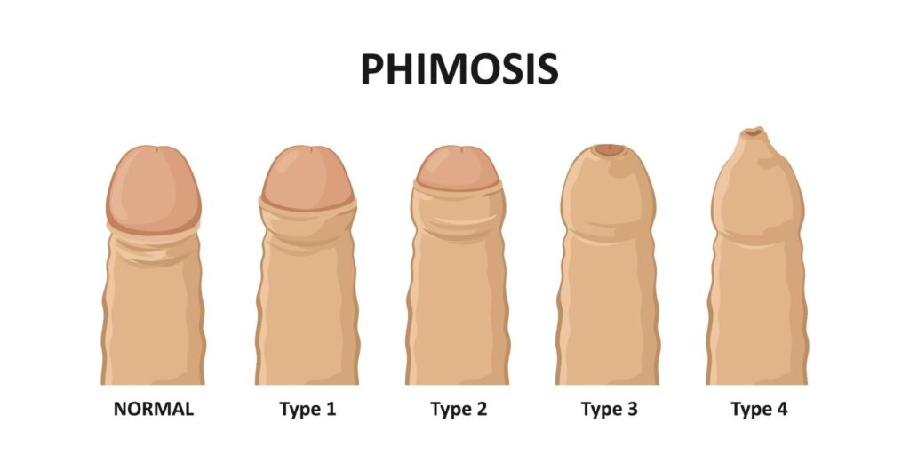Best Phimosis Doctor in Surat | ZSR Circumcision Doctor