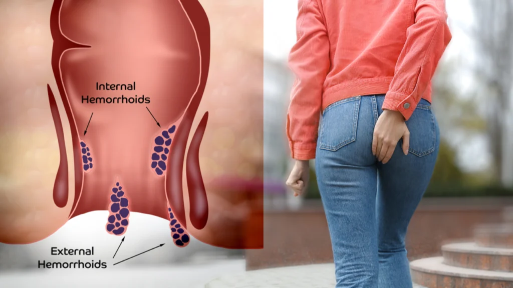 Best Piles Treatment in Udhna, Surat | Dr.Anup Patki