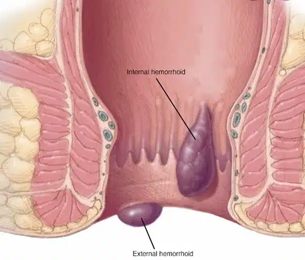 Best Piles treatment in Surat | Piles Laser Treatment