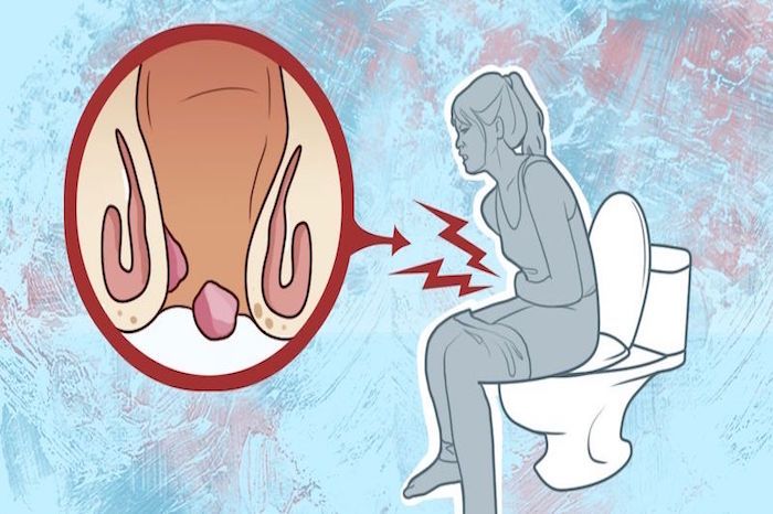 Piles Doctor in Surat Near Me | Dr.Anup Patki