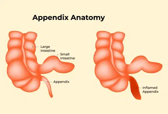 Appendix operation cost in Bardoli | Dr. Anup Patki