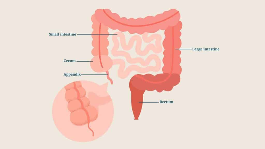 Appendix Surgery Cost in Surat | Dr. Anup Patki